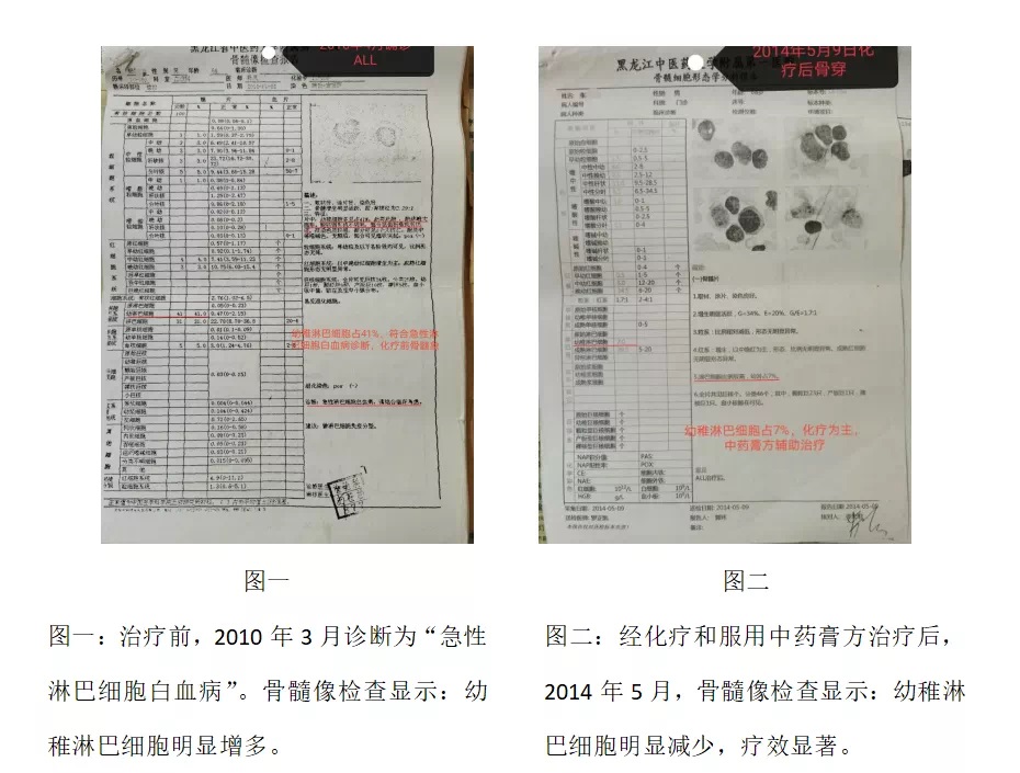 医案精粹：张雅丽教授医案--淋巴细胞白血病